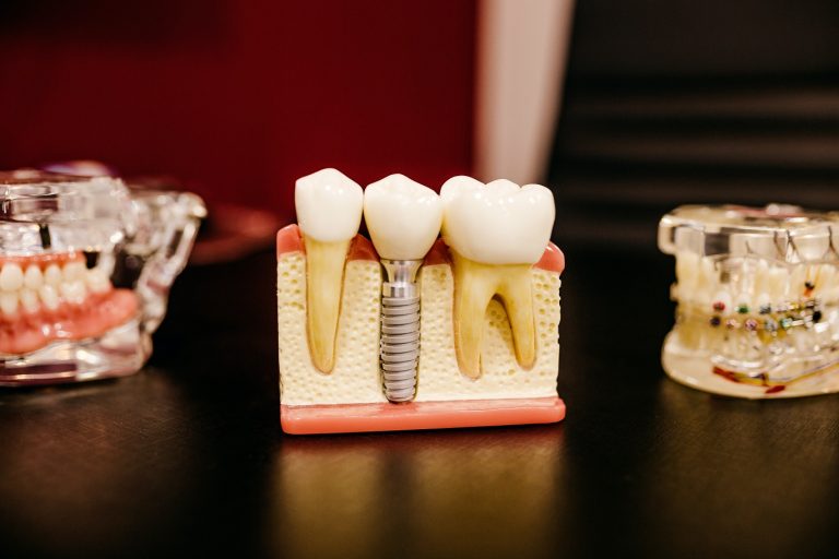 Discover the Magic of a Perfect Smile with Dr. Lieu and Blue Apple Dental Group: Rohnert Park’s Top Destination for Dental Implants